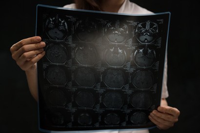 TRANSALC study uses brain imaging to test treatments